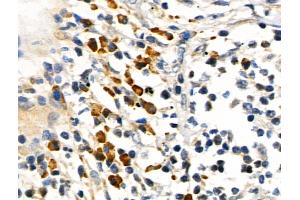 Phospho-RUNX2 (Ser319) Antibody at 1/100 staining Human lung cancer by IHC-P. (RUNX2 抗体  (pSer319))