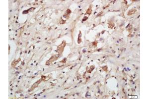 Formalin-fixed and paraffin embedded human lung carcinoma labeled with Rabbit Anti-IGFBP7 Polyclonal Antibody, Unconjugated  at 1:200 followed by conjugation to the secondary antibody and DAB staining (IGFBP7 抗体  (AA 131-230))