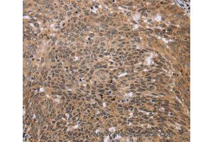 Immunohistochemistry of Human colon cancer using ERCC6L Polyclonal Antibody at dilution of 1:30 (ERCC6L 抗体)