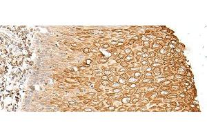 Immunohistochemistry of paraffin-embedded Human esophagus cancer tissue using FAM155B Polyclonal Antibody at dilution of 1:30(x200) (FAM155B 抗体)