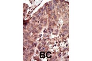 Formalin-fixed and paraffin-embedded human cancer tissue reacted with the primary antibody, which was peroxidase-conjugated to the secondary antibody, followed by AEC staining. (PKLR 抗体  (C-Term))