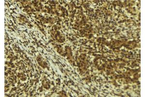 ABIN6273995 at 1/100 staining Human breast cancer tissue by IHC-P. (BRD4 抗体  (N-Term))