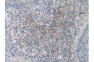 IHC-P analysis of Human Skin Cancer Tissue, with DAB staining. (FDFT1 抗体  (AA 269-417))
