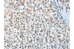 The image on the left is immunohistochemistry of paraffin-embedded Human esophagus cancer tissue using ABIN7128286(AGBL3 Antibody) at dilution 1/25, on the right is treated with fusion protein. (AGBL3 抗体)