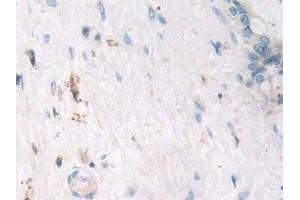 Detection of TNFa in Human Bile duct cancer Tissue using Polyclonal Antibody to Tumor Necrosis Factor Alpha (TNFa)