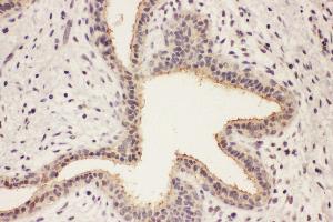 Anti-RAB8A antibody, IHC(P) IHC(P): Human Mammary Cancer Tissue (RAB8A 抗体  (C-Term))