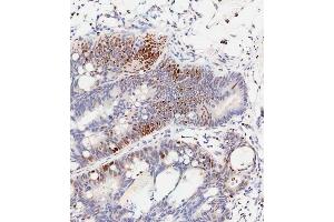 Immunohistochemical analysis of paraffin-embedded Human colon carcinoma tissue using (ABIN389547 and ABIN2839591) performed on the Leica® BOND RXm. (CREB1 抗体  (pSer133))