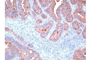 Formalin-fixed, paraffin-embedded human Colon Carcinoma stained with CEA, pan Mouse Monoclonal Antibody (Cocktail) (CEACAM5 抗体)