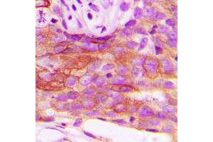 Immunohistochemical analysis of HSL staining in human breast cancer formalin fixed paraffin embedded tissue section. (LIPE 抗体  (Center))