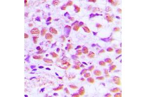 Immunohistochemical analysis of SAE1 staining in human breast cancer formalin fixed paraffin embedded tissue section.