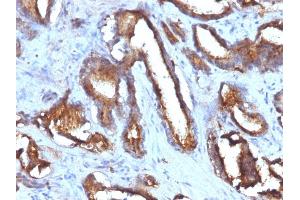 Formalin-fixed, paraffin-embedded human Prostate Carcinoma stained with CD63 Monoclonal Antibody (NKI/C3 + LAMP3/968) (CD63 抗体)