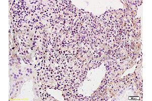 Immunohistochemistry (Paraffin-embedded Sections) (IHC (p)) image for anti-BRCA1 Interacting Protein C-terminal Helicase 1 (BRIP1) (pSer990) antibody (ABIN2170674)