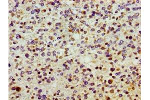 Immunohistochemistry of paraffin-embedded human glioma using ABIN7170545 at dilution of 1:100 (SMOX 抗体  (AA 268-353))