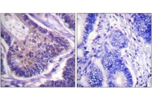 Immunohistochemistry analysis of paraffin-embedded human colon carcinoma tissue, using eIF4B (Ab-422) Antibody. (EIF4B 抗体  (AA 388-437))