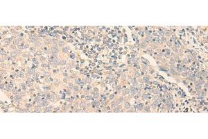 Immunohistochemistry of paraffin-embedded Human cervical cancer tissue using GCDH Polyclonal Antibody at dilution of 1:30(x200) (GCDH 抗体)