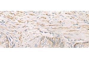 Immunohistochemistry of paraffin-embedded Human prost at e cancer tissue using STOML2 Polyclonal Antibody at dilution of 1:25(x200) (STOML2 抗体)