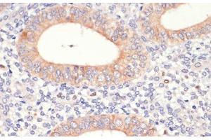 Immunohistochemistry of paraffin-embedded Human uterine cancer using HMGCR Polyclonal Antibody at dilution of 1:200 (40x lens). (HMGCR 抗体)