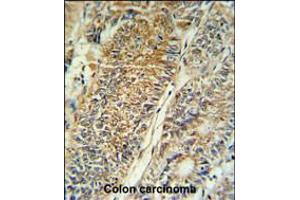 PYCR1 Antibody IHC analysis in formalin fixed and paraffin embedded colon carcinoma followed by peroxidase conjugation of the secondary antibody and DAB staining. (PYCR1 抗体  (C-Term))
