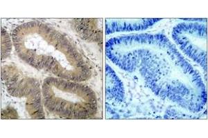 Immunohistochemistry analysis of paraffin-embedded human colon carcinoma, using IKK-alpha (Phospho-Thr23) Antibody.