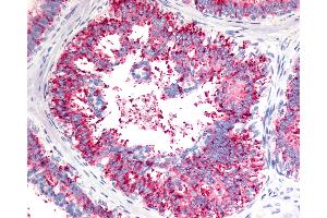 Anti-V1RL1 / VN1R1 antibody IHC of human Breast, Carcinoma. (VN1R1 抗体  (C-Term))
