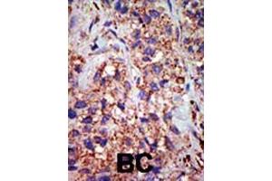 Formalin-fixed and paraffin-embedded human cancer tissue reacted with the primary antibody, which was peroxidase-conjugated to the secondary antibody, followed by DAB staining. (USP8 抗体  (C-Term))