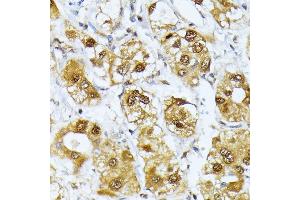 Immunohistochemistry of paraffin-embedded human liver cancer using RRAGD antibody (ABIN6132084, ABIN6147254, ABIN6147255 and ABIN6225325) at dilution of 1:100 (40x lens). (RRAGD 抗体  (AA 181-400))