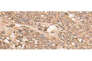 Immunohistochemistry of paraffin-embedded Human liver cancer tissue using B4GALNT2 Polyclonal Antibody at dilution of 1:35(x200) (B4GALNT2 抗体)