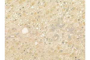 ABIN6264322 and ABIN6277635 at 1/100 staining human astrocytoma by IHC-P.