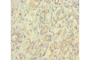 Immunohistochemistry of paraffin-embedded human pancreatic cancer using ABIN7152209 at dilution of 1:100 (EIF5 抗体  (AA 1-431))