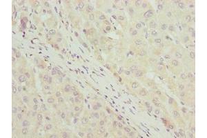 Immunohistochemistry of paraffin-embedded human liver cancer using ABIN7158480 at dilution of 1:100 (Uncharacterized Protein C7orf34 (LLCFC1) (AA 29-122) 抗体)