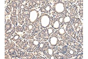 The image on the left is immunohistochemistry of paraffin-embedded Human thyroid cancer tissue using ABIN7131585(VPS37D Antibody) at dilution 1/30, on the right is treated with fusion protein. (VPS37D 抗体)