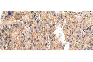 Immunohistochemistry of paraffin-embedded Human liver cancer using VAMP5 Polyclonal Antibody at dilution of 1/25 (VAMP5 抗体)