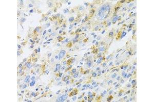 Immunohistochemistry of paraffin-embedded Human liver cancer using CXCR3 Polyclonal Antibody at dilution of 1:100 (40x lens). (CXCR3 抗体)