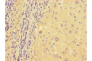 Immunohistochemistry of paraffin-embedded human liver cancer using ABIN7150136 at dilution of 1:100 (DDIT4L 抗体  (AA 1-163))