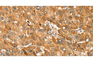 Immunohistochemistry of paraffin-embedded Human liver cancer using TRIM62 Polyclonal Antibody at dilution of 1:30 (TRIM62 抗体)