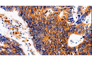 Immunohistochemistry of paraffin-embedded Human colon cancer tissue using IL18BP Polyclonal Antibody at dilution 1:50 (IL18BP 抗体)