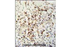 HAUS5 Antibody immunohistochemistry analysis in formalin fixed and paraffin embedded human colon carcinoma followed by peroxidase conjugation of the secondary antibody and DAB staining. (HAUS5 抗体  (N-Term))