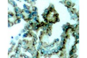 Immunohistochemistry of paraffin-embedded Human lung carcinoma tissue, using Phospho-PKCalpha/beta II(T638/641) Polyclonal Antibody (PRKCA beta 2 抗体  (pThr638, pThr641))