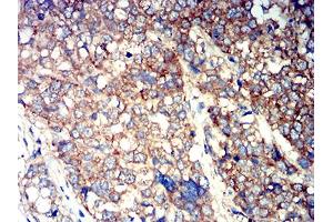 Immunohistochemical analysis of paraffin-embedded breast cancer tissues using ATG3 mouse mAb with DAB staining. (ATG3 抗体  (AA 1-100))