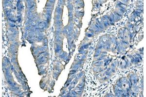 IHC analysis of B Raf/BRAF using anti-B Raf/BRAF antibody (ABIN3043761). (BRAF 抗体  (AA 38-230))