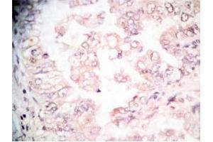 Human lung cancer tissue stained by Rabbit-Anti-GRP Pro (80-97) (H) Antibody (Gastrin-Releasing Peptide 抗体  (AA 80-97))