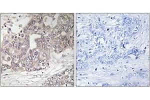 Immunohistochemistry analysis of paraffin-embedded human liver carcinoma tissue, using ATG4C Antibody. (ATG4C 抗体  (AA 21-70))