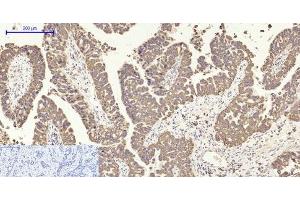 Immunohistochemistry of paraffin-embedded Human liver cancer tissue using COX2 Polyclonal Antibody at dilution of 1:200. (COX2 抗体)