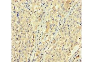 Immunohistochemistry of paraffin-embedded human lung cancer using ABIN7170528 at dilution of 1:100 (SPATS1 抗体  (AA 1-300))