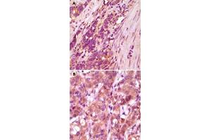 Immunohistochemical analysis of paraffin-embedded human stomach carcinoma(A) and breast carcinoma (B) tissue, showing cytoplasmical localization, using FBLN5 monoclonal antibody, clone 3F10A5, 3F8A12  with DAB staining. (Fibulin 5 抗体)