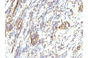 Formalin-fixed, paraffin-embedded human Leiomyosarcoma stained with anti-Vimentin antibody. (Vimentin 抗体)