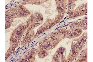 Immunohistochemistry of paraffin-embedded human endometrial cancer using ABIN7142023 at dilution of 1:100 (AGPAT5 抗体  (AA 174-313))