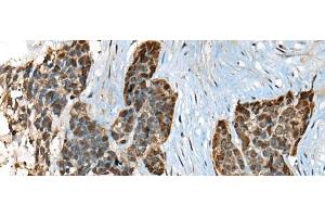 Immunohistochemistry of paraffin-embedded Human thyroid cancer tissue using CALML5 Polyclonal Antibody at dilution of 1:70(x200) (CALML5 抗体)