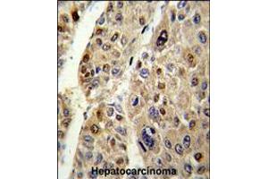 Formalin-fixed and paraffin-embedded human hepatocarcinoma reacted with SERPINC1 Antibody , which was peroxidase-conjugated to the secondary antibody, followed by DAB staining. (SERPINC1 抗体  (C-Term))