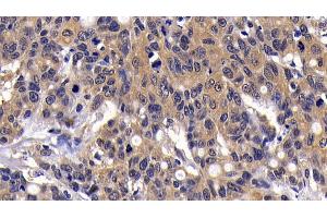 Detection of MIP3b in Human Lymphoma Tissue using Polyclonal Antibody to Macrophage Inflammatory Protein 3 Beta (MIP3b) (CCL19 抗体  (AA 22-98))